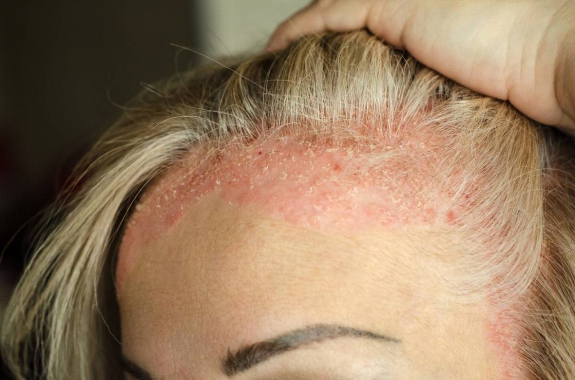 Gros plan sur la lisière frontale des cheveux d'une femme présentant des plaques rouges et squameuses caractéristiques d'un psoriasis du cuir chevelu.